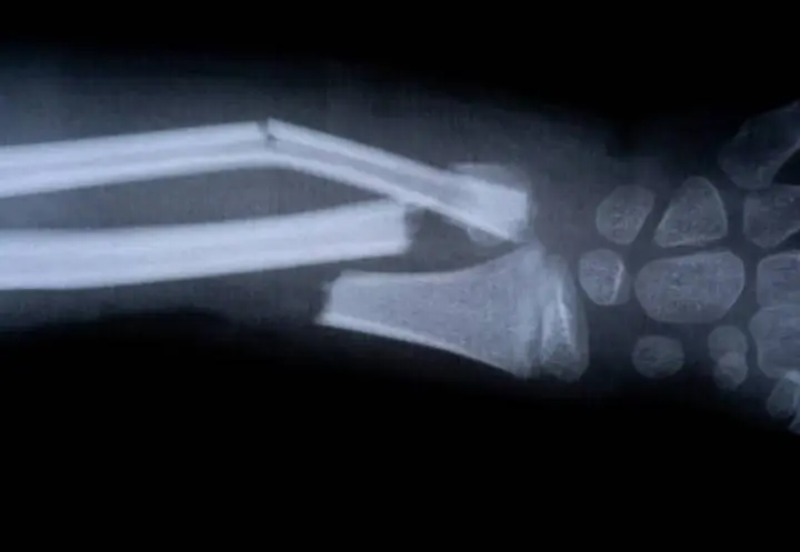 Клей для костей